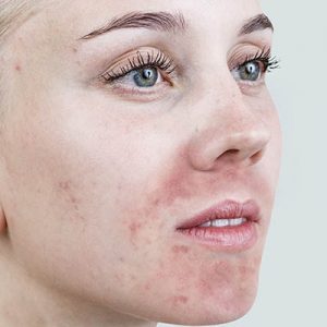 perioral dermatit